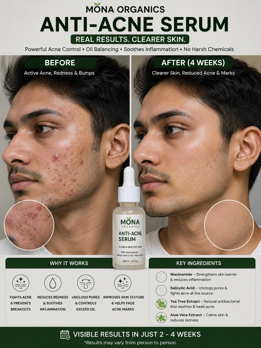 Anti Acne Serum
